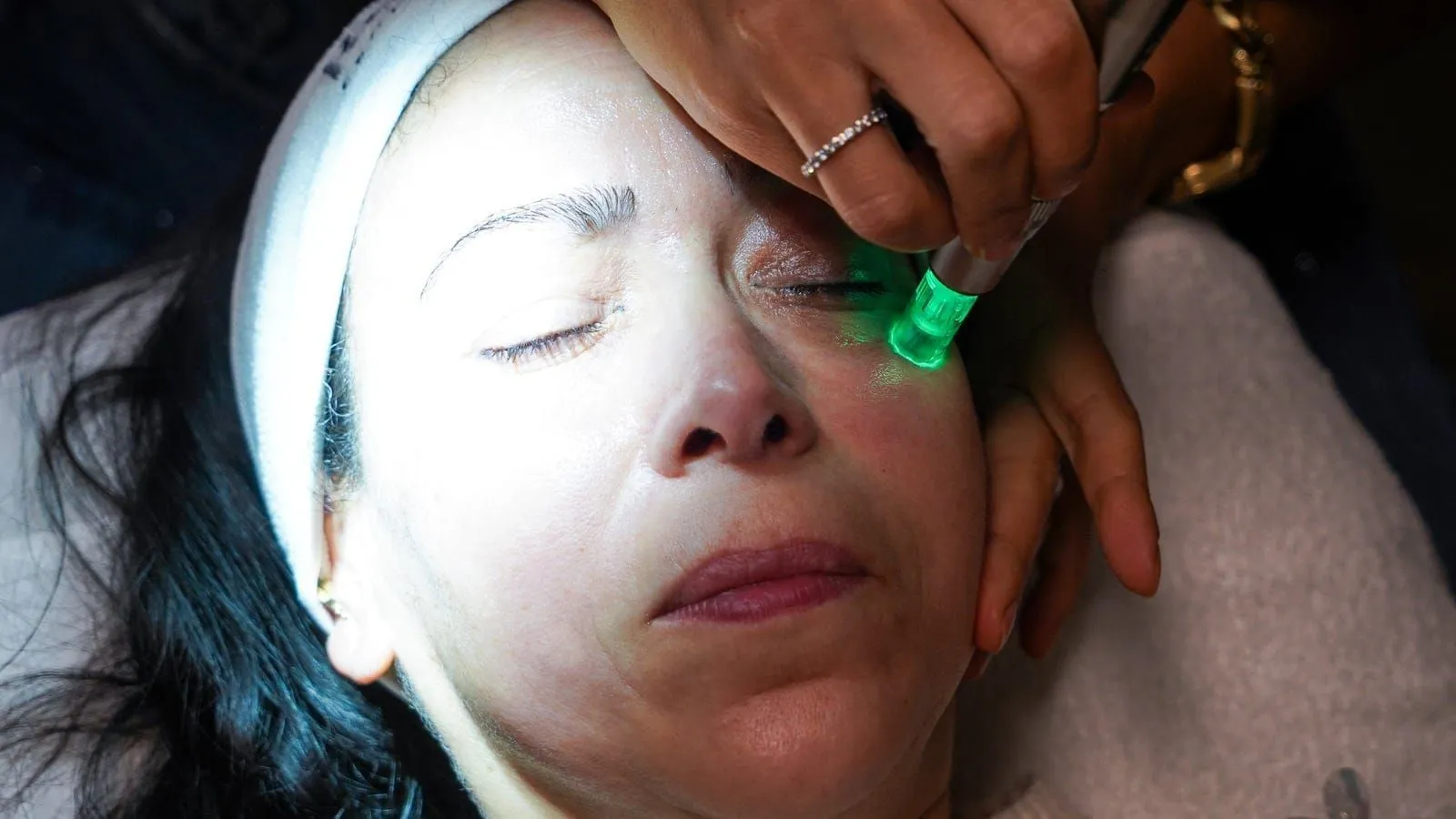 Microneedling, photo 2