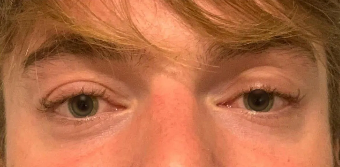 AVANT - Ptosis (RCM)