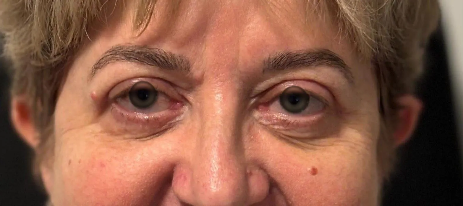 APRÈS - Blépharoplastie supérieure