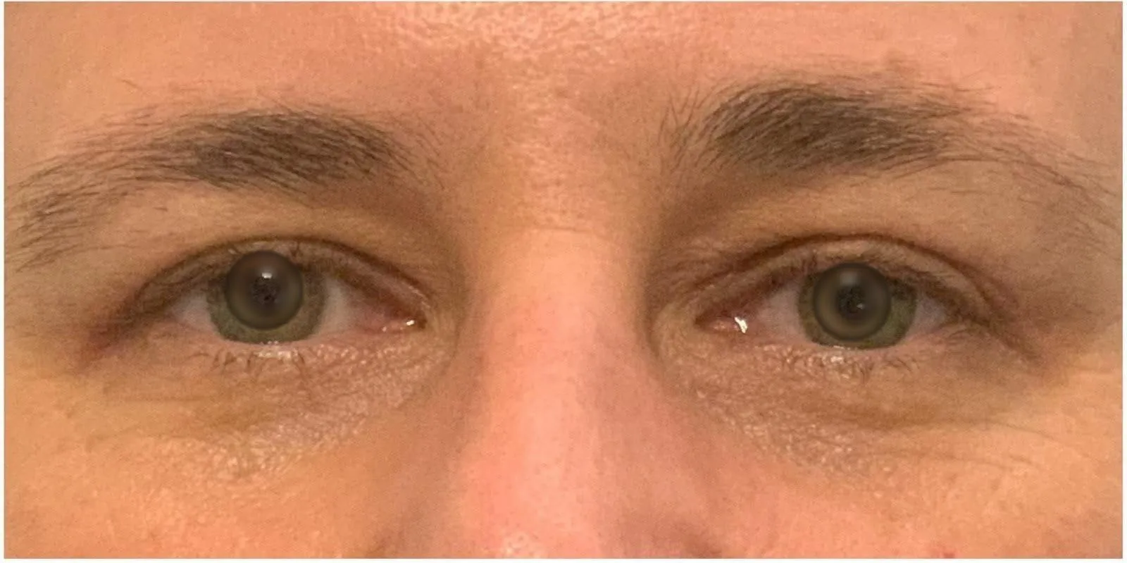 APRÈS - Blépharoplastie supérieure