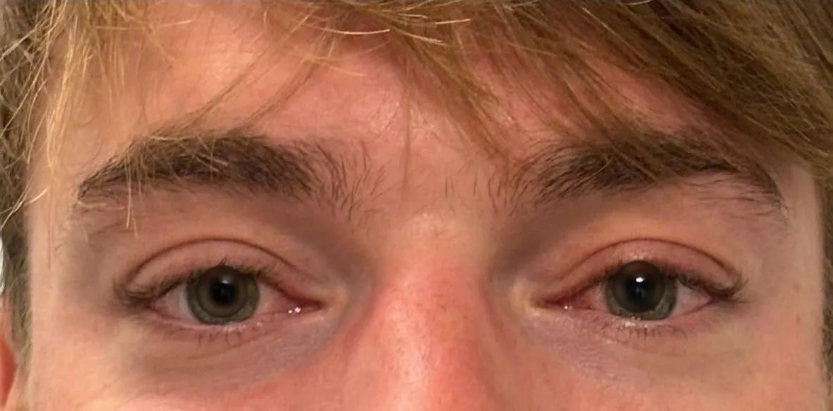 APRÈS - Ptosis (RCM)