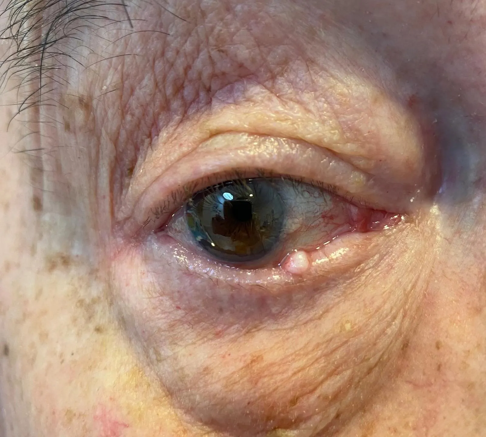 Lésion maligne - Carcinoma basocellulaire nodulaire