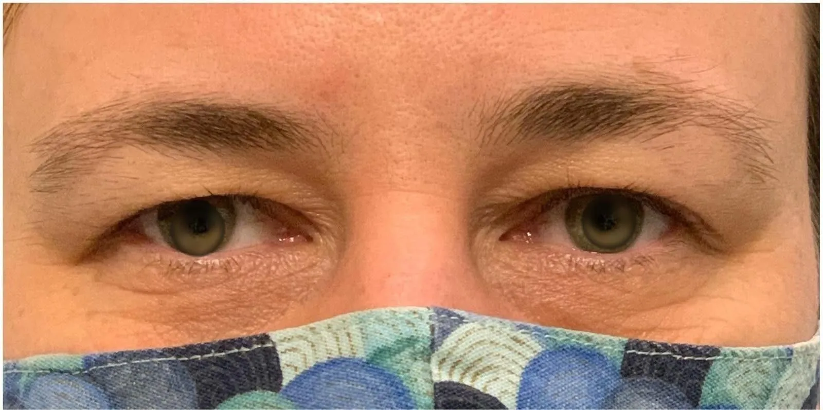 AVANT - Blépharoplastie supérieure