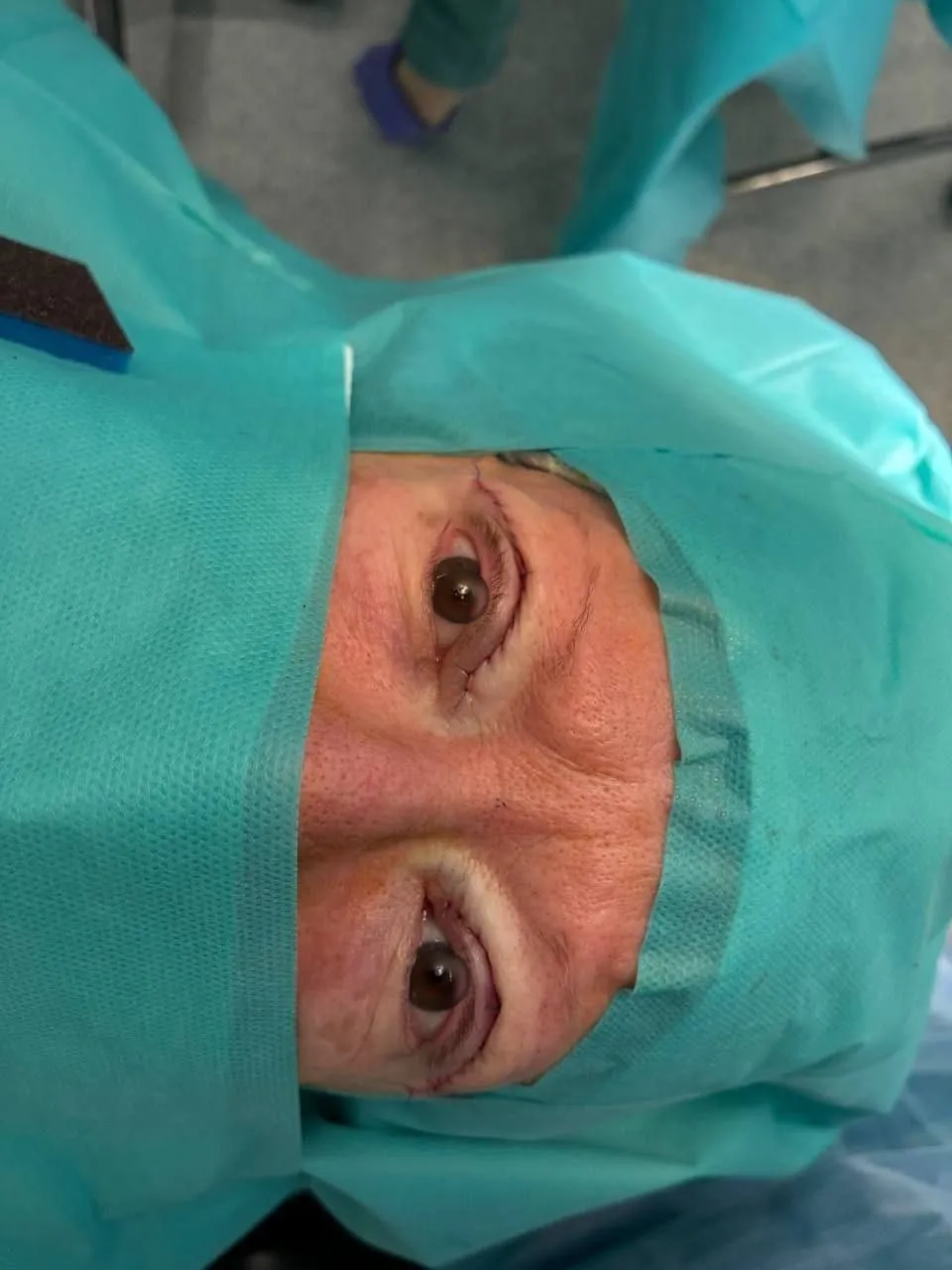 Chirurgie du Ptosis, photo 1