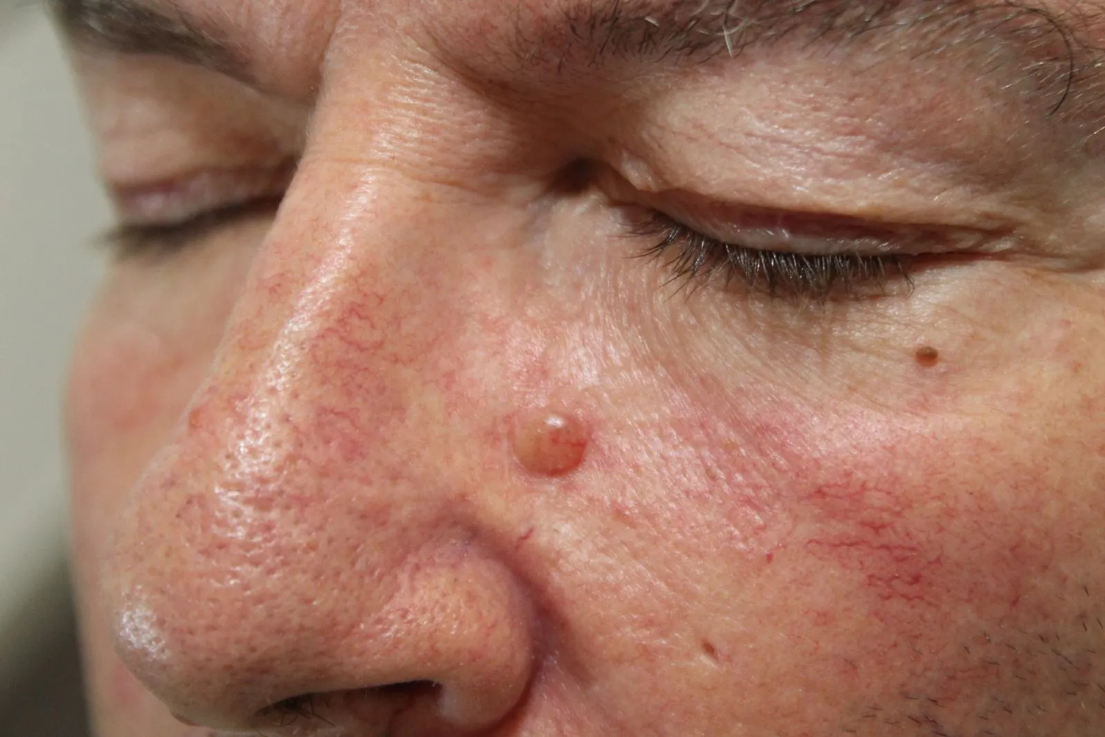 AVANT - Lésion maligne Carcinome basocellulaire périoculaire