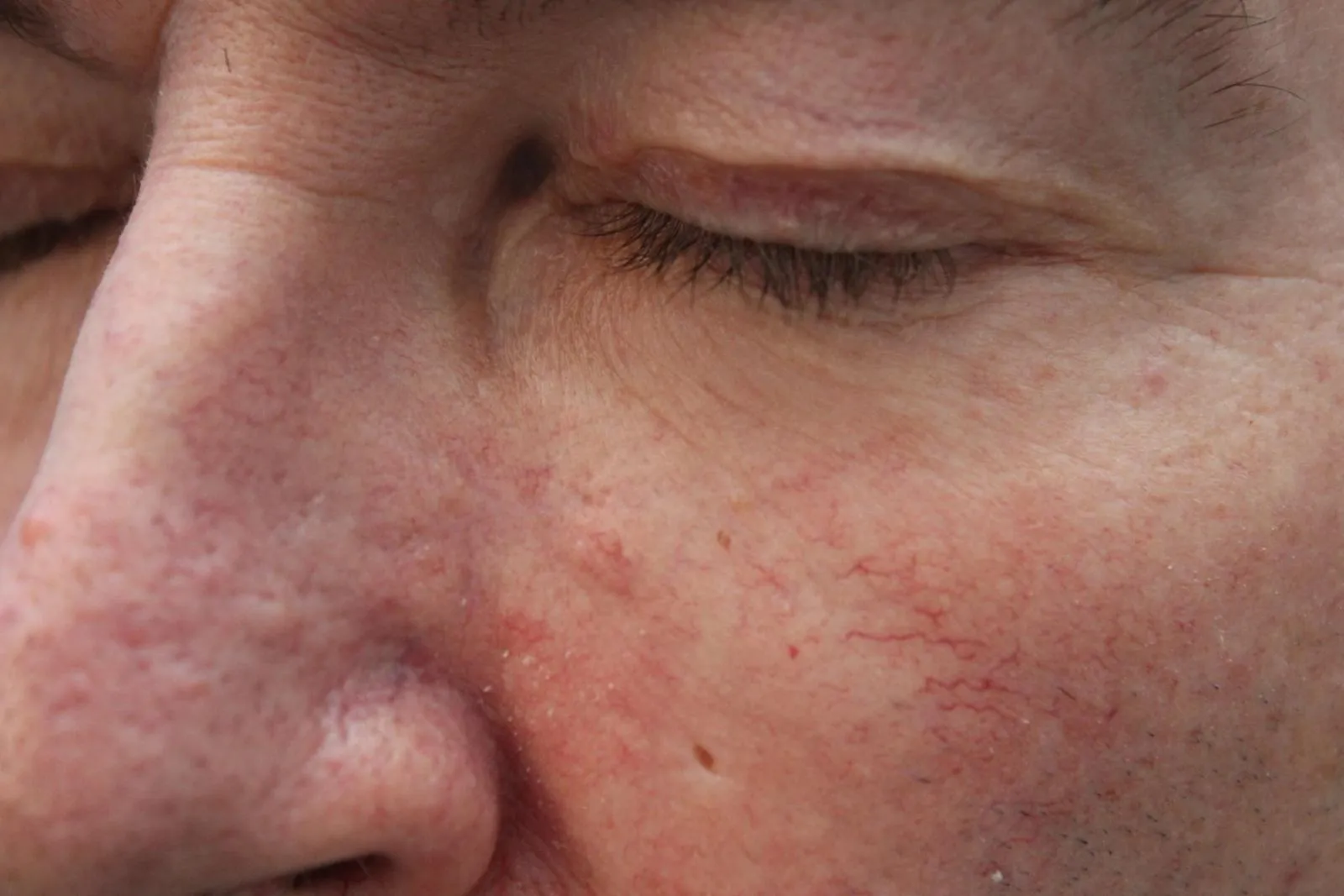 APRÈS - Lésion maligne Carcinome basocellulaire périoculaire