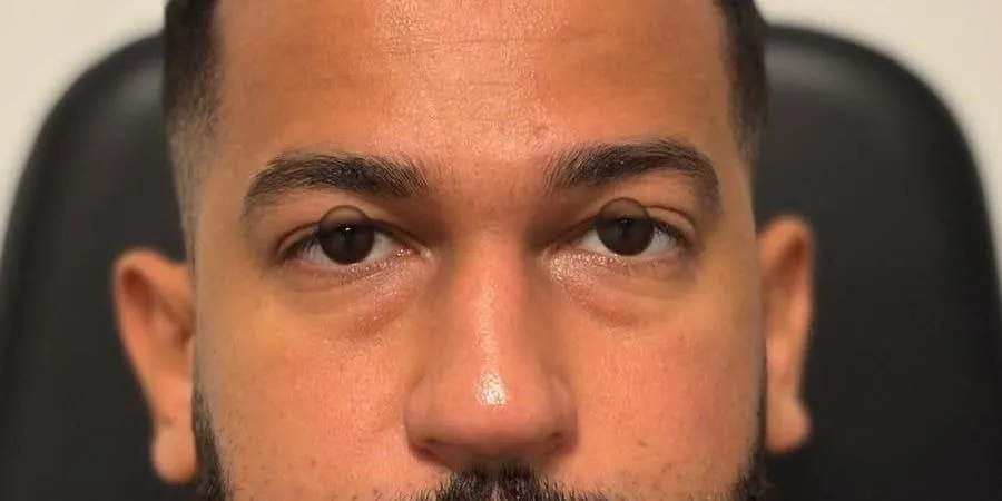 AVANT - Blépharoplastie supérieure