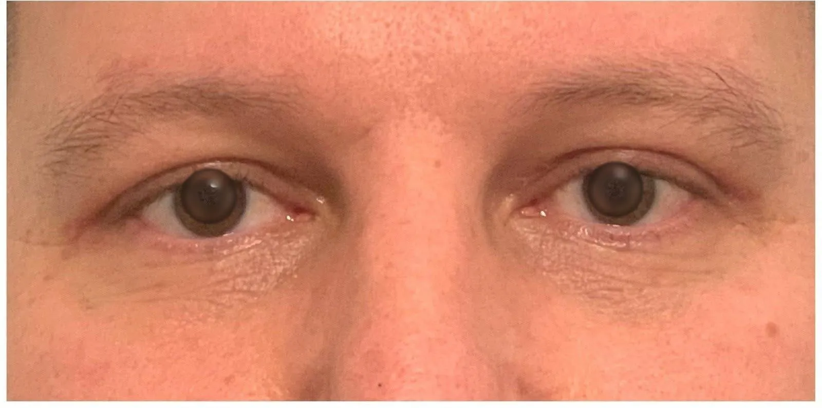 APRÈS - Blépharoplastie supérieure