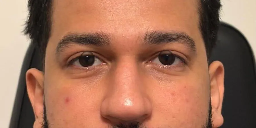 APRÈS - Blépharoplastie supérieure
