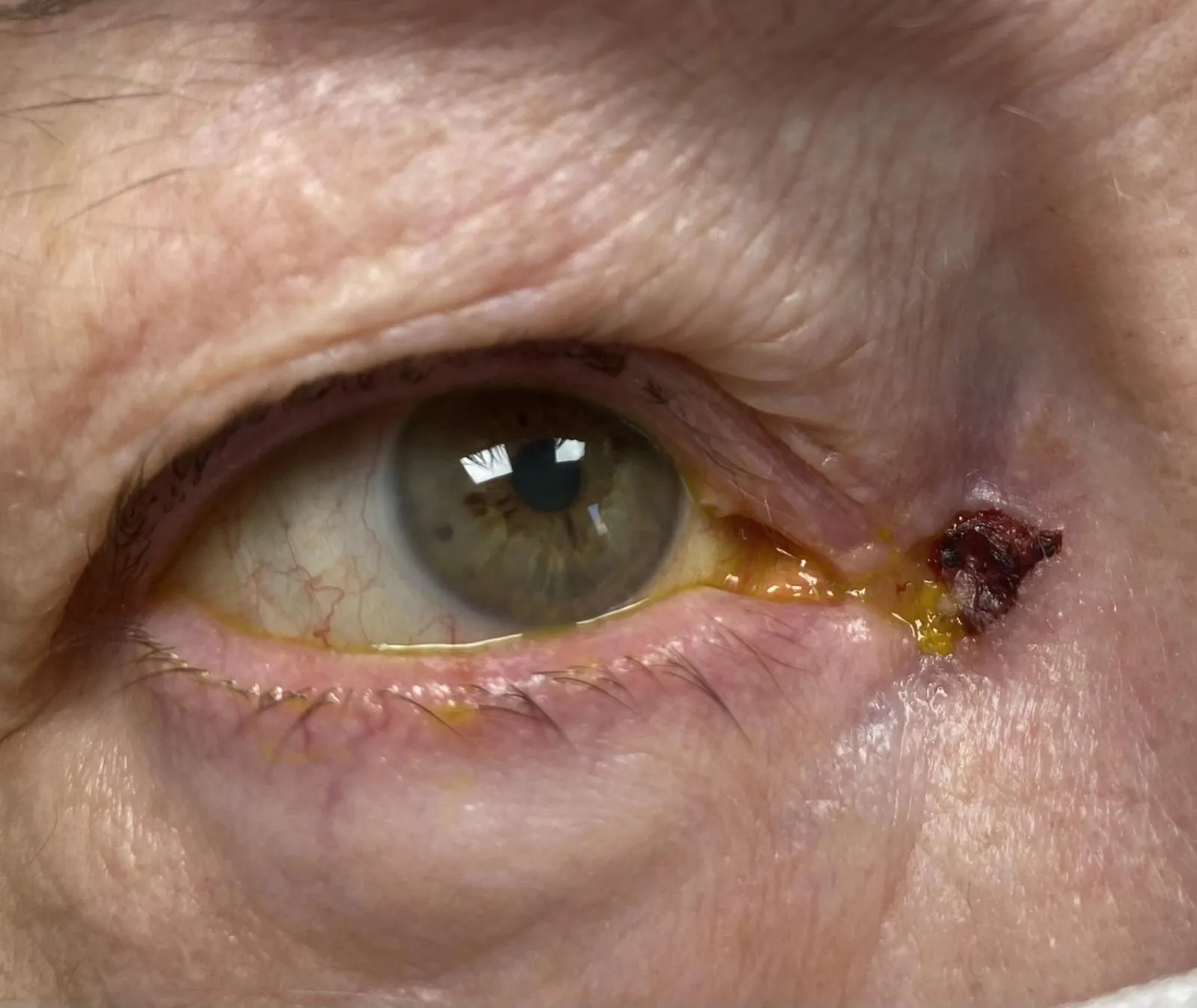 Lésion maligne- carcinoma basoellulaire infiltratif