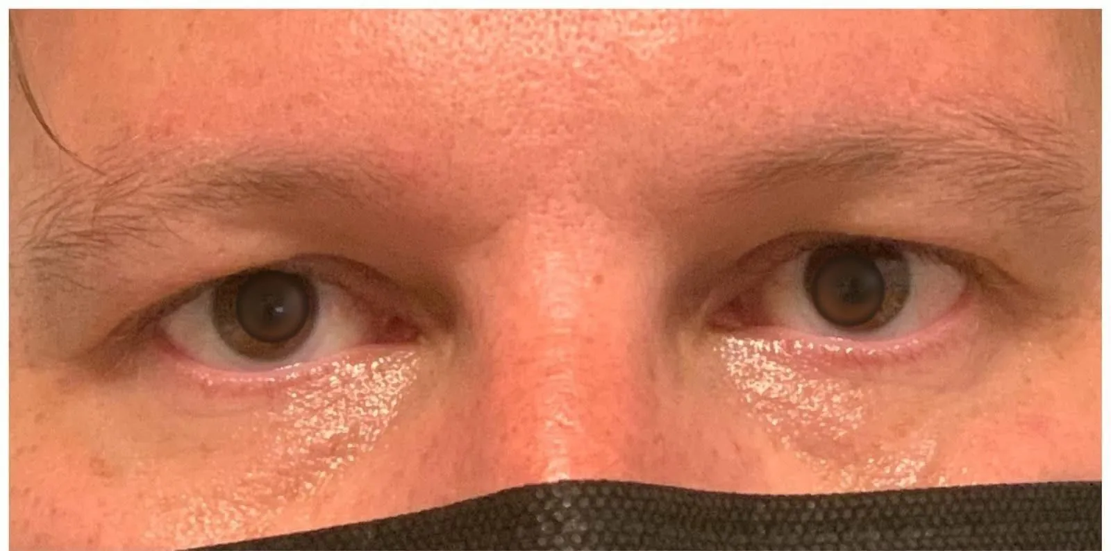 AVANT - Blépharoplastie supérieure