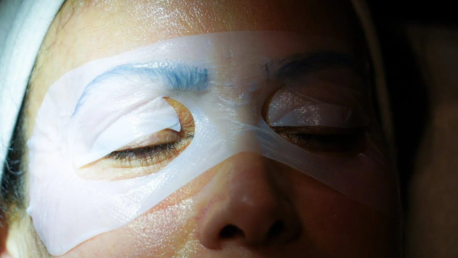 Microneedling, photo 3