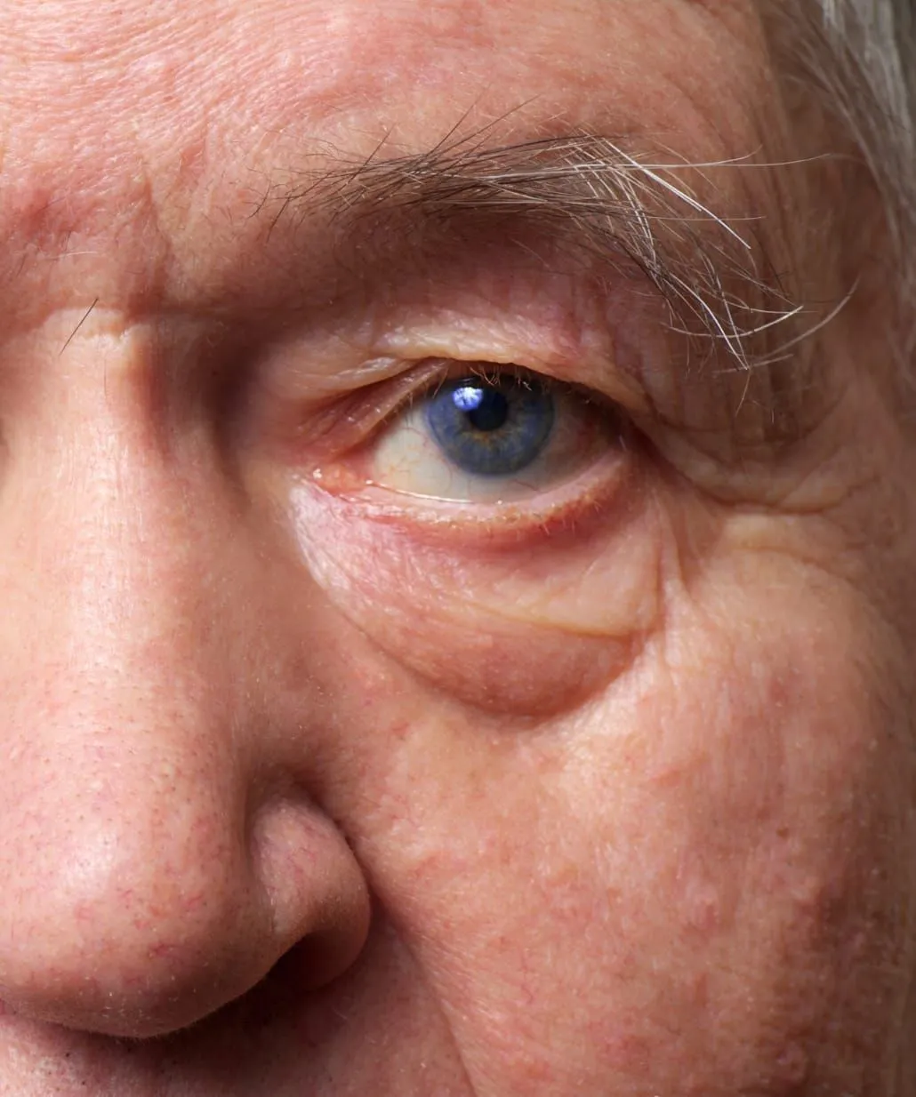 Des poches sous les yeux