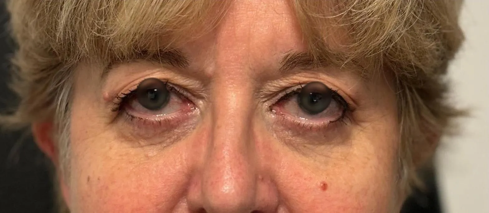 AVANT - Blépharoplastie supérieure