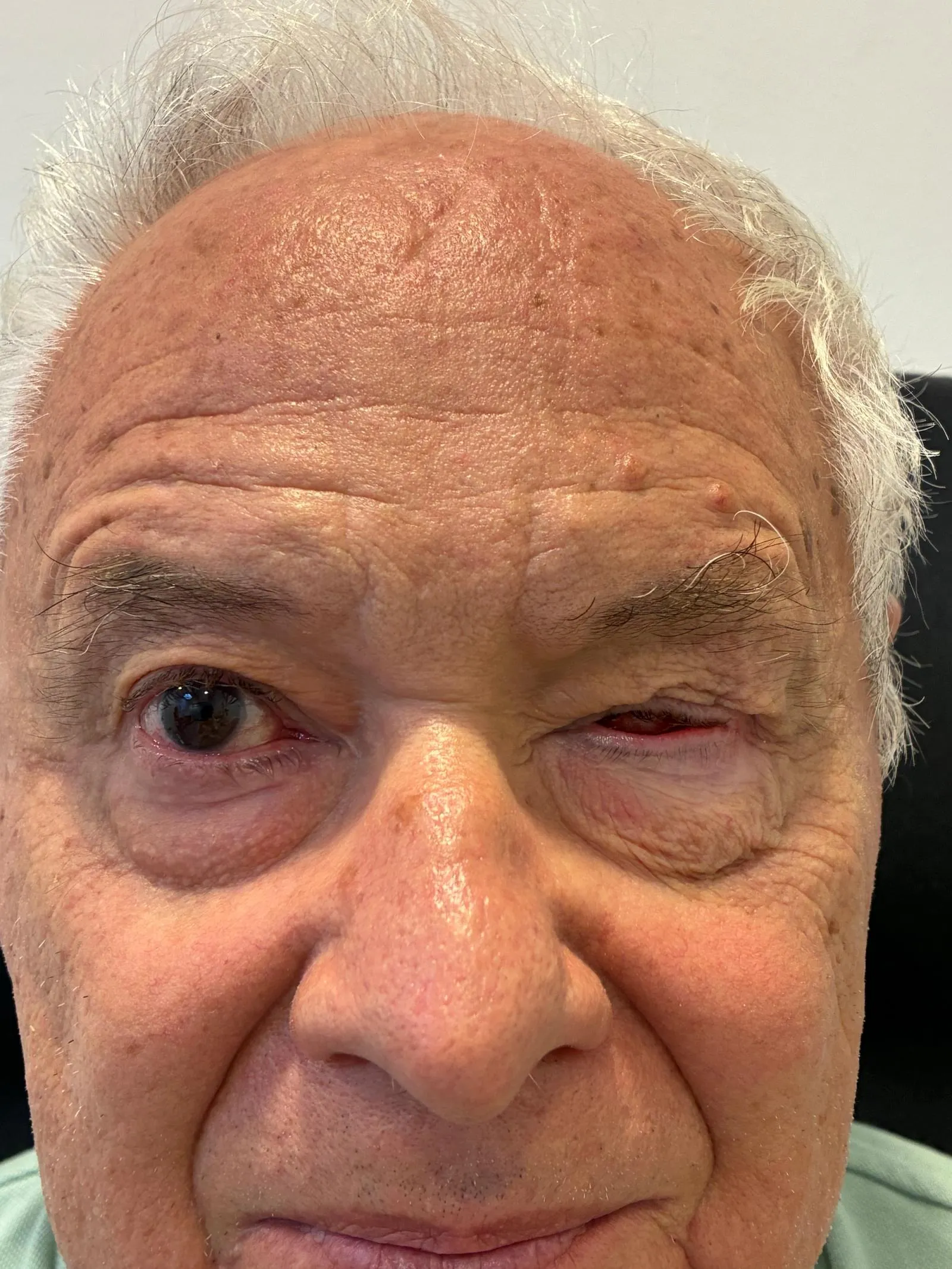 AVANT - Patient avec Eviscération. Photo sans/avec prothèse