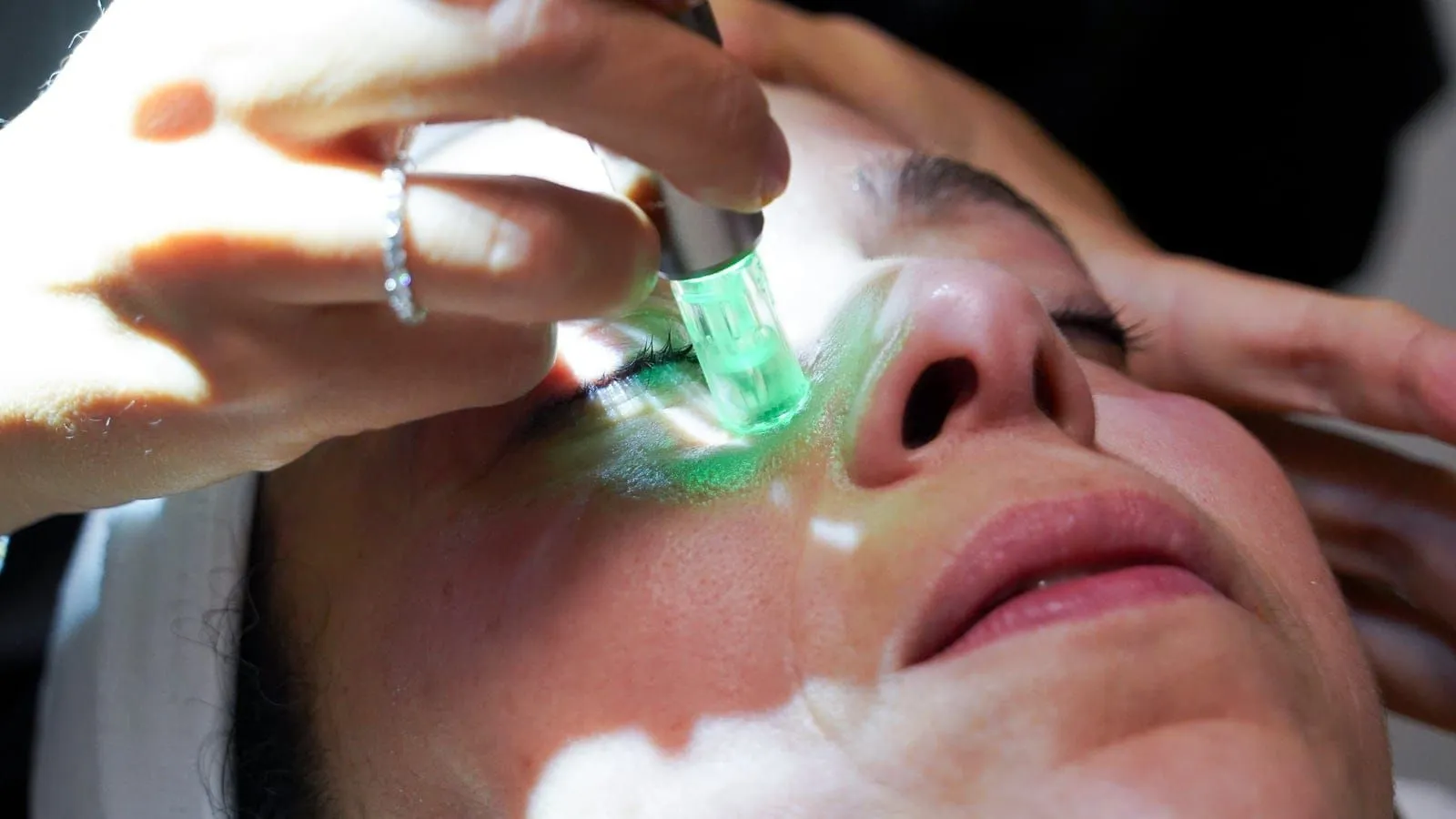 Microneedling, photo 1
