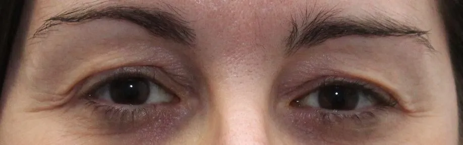 Blépharoplastie Supérieure